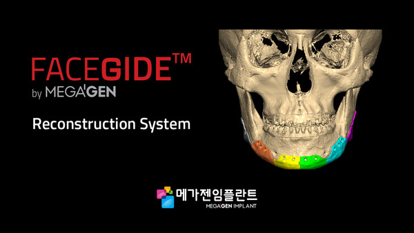 메가젠이 FACEGIDE Reconstruction System의 환자맞춤형 '인공 하악골'을 개발했다.