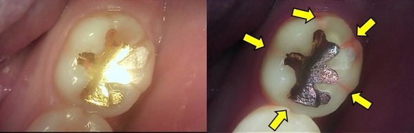 Qray로 찍은 형광사진(오른쪽)을 통해 치아균열 상태도 확인할 수 있다.(사진제공= 아이오바이오)